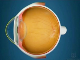 Miopia_Ojo_miope_cornea_exceso_curvatura_Oftalnova_Oftalmologos_Barcelona