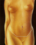Cicatriz resultante de la abdominoplastia