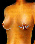Reubicación de la areola en la mastopexia