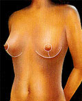 Cicatrices de la mastopexia