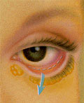 Imagen de blefaroplastia transconjuntival