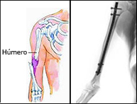 Fracturas de húmero