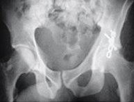 Fracturas de acetábulo_02