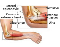 Traumatismos del codo