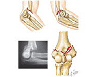 Fracturas de paleta humeral