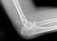 Fracturas de olécranon