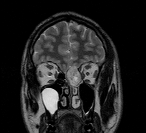 tratamiento de enfermedades tumorales y malformaciones que afectan a la base del cráneo imagen