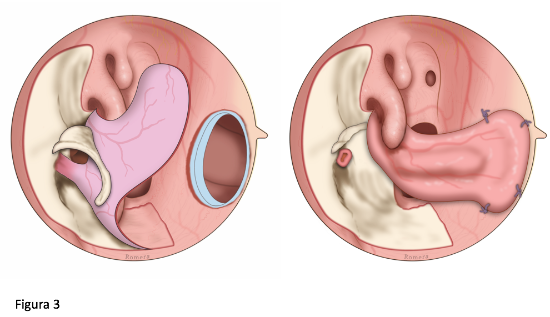 Colgajo de la pared nasal lateral
