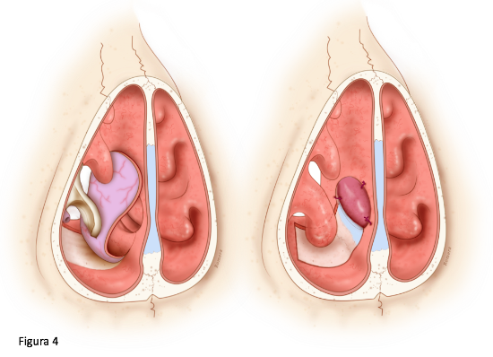 Colgajo del suelo nasal
