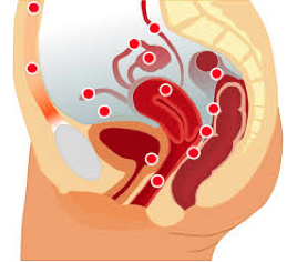 Endometriosis
