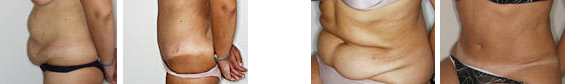 Abdominoplastia_01
