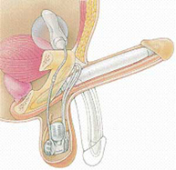 Esquema de la prótesis de pene