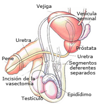 vasovasostomía