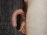3. Incurvación congénita de pene, lateral