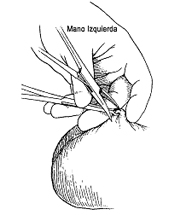 Punción de la luz del deferente.
