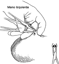 Disección del deferente.