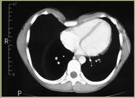 Resonancia-Magnética-Pectus-Excavatum