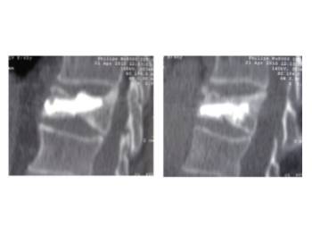 Ejemplo caso clínico cifoplastia 5