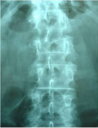 pre- y post-operatoria de una cifopastia cementada