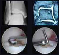 Imagen de rayos X, resonancia magnética y reparación de cartílago
