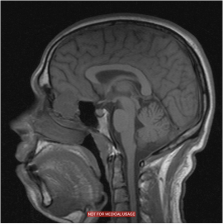 tratamiento de enfermedades tumorales y malformaciones que afectan a la base del cráneo