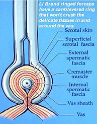 Fijación del deferente.