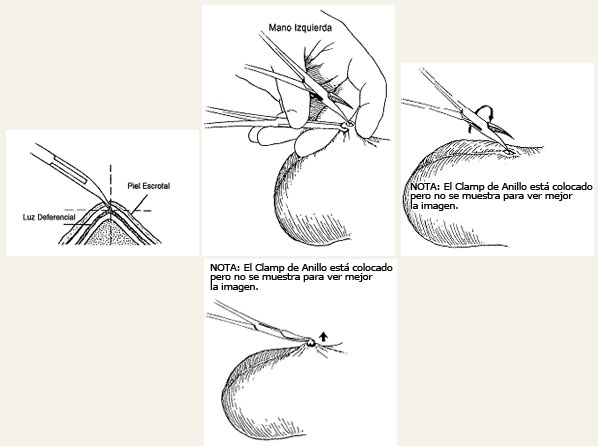 Exteriorización del deferente.