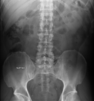 RX Abdomen
