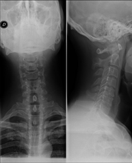 RX Columna cervical