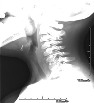 RX Cuello partes blandas