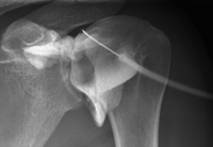 RX Artrografía