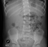 RX Abdomen