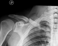 RX Clavículas