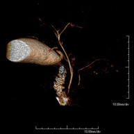 Colangio-RM (RM Vesícula y vía biliar)