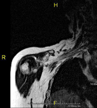 RM de Plexe braquial