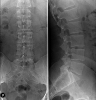RX Columna lumbar