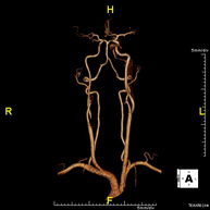 Angio-RM de troncs supraaòrtics