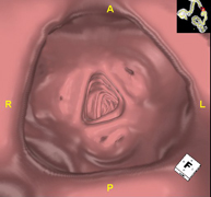 Colonoscopia virtual_2