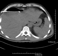 Drenaje abdominal guiado por TC
