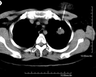 Biopsia tórax guiada por TC