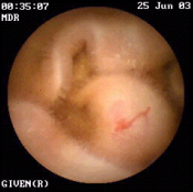 Cápsula endoscópica 3