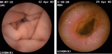 Cápsula endoscópica 2