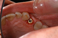 Implantes