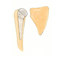 Hemiartroplastia