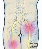 Nervio ciático