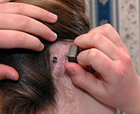 implantes osteointegrados