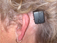 Implantes Osteointegrados_