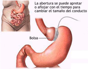 Técnicas que reducen el estómago