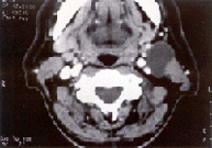 Fístulas, senos y quistes branquiales_2