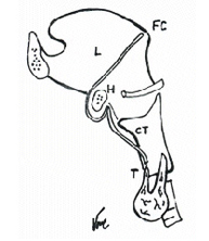 Quiste del conducto tireogloso_1